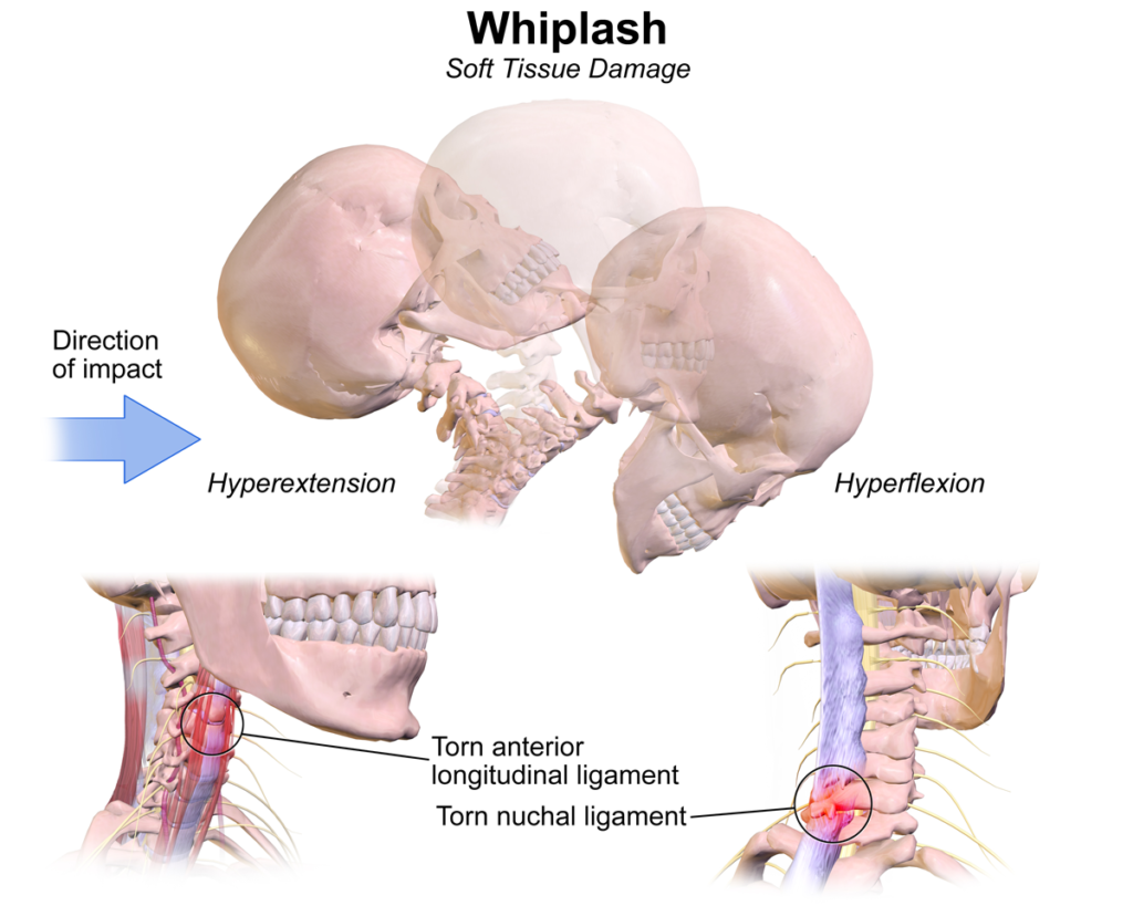 Atlanta Personal Injury | Atlanta Spine Center